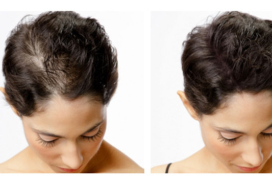 1716909636_96_5e98cded5f512208c7ad3246_alopecia_tattoo_nyc.jpg